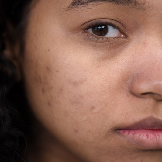 Unveiling the Six Root Causes of Acne (and Their Solutions)